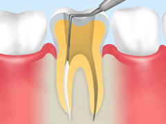 重度の虫歯には根管治療