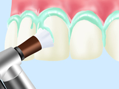 PMTC（Professional Mechanical Tooth Cleaning）