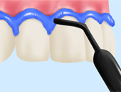 Step 03 歯ぐきの保護